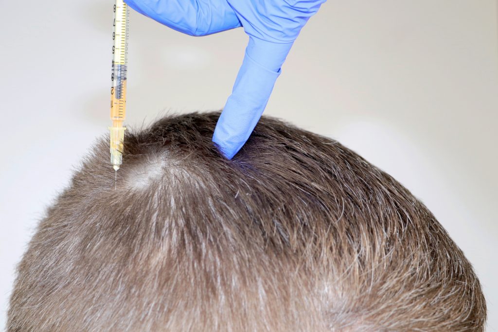 best hair transplant in turkey